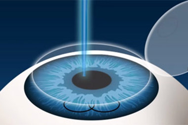 Refractive Surgery & Lasik - Dr. Shyam Agrawal - Agarwal Eye Hospital